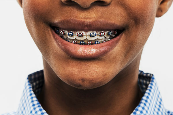 Woodhaven Braces | Frenillos tradicionales, Invisalign reg  and Ortodoncia para adultos jovenes